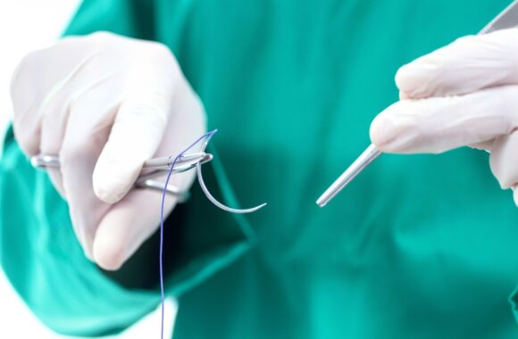 sutures